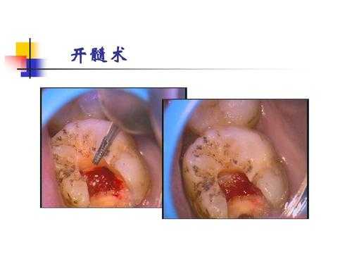 开髓过程（开髓的视频）-图1