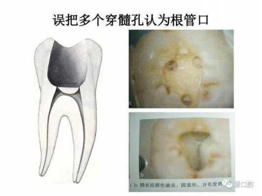 开髓过程（开髓的视频）-图2