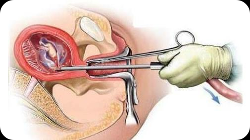 什么是刮宫手术过程（什么叫刮宫手术）-图3