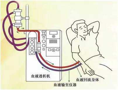 透析过程血流量（透析过程血流量低）-图1