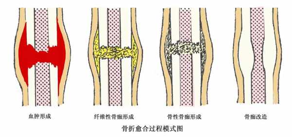 骨的愈合过程（骨愈合过程的几个阶段）-图1