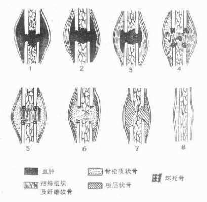 骨的愈合过程（骨愈合过程的几个阶段）-图3