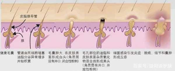 黑头形成过程（黑头的形成机制）-图1