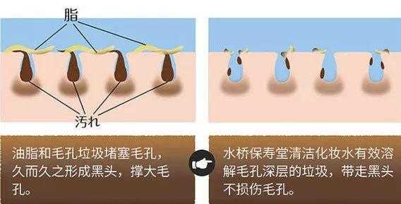 黑头形成过程（黑头的形成机制）-图2