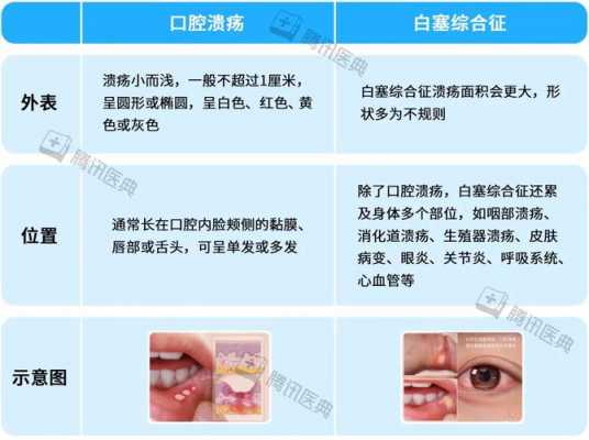 口疮发展过程（口疮的病变部位）-图3