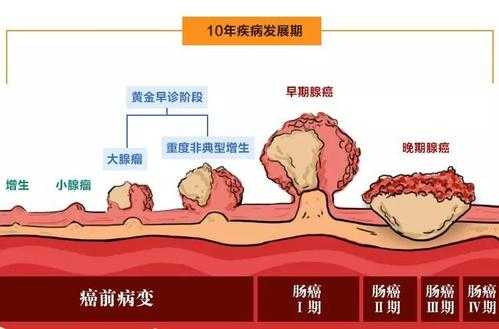 肠癌的变化过程（肠癌的变化过程图）-图1