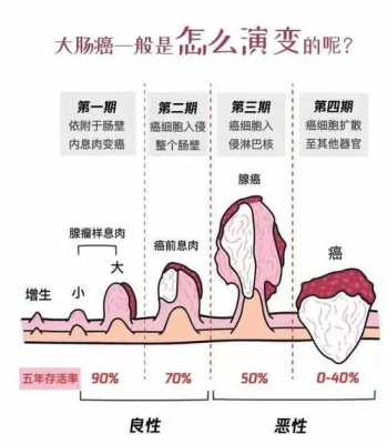 肠癌的变化过程（肠癌的变化过程图）-图3