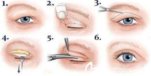 双眼皮埋线过程（双眼皮埋线过程图视频）-图3