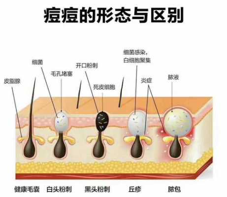 痘痘消失的过程（痘痘消失的过程图片）-图1