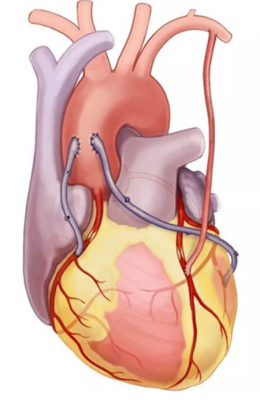 心电搭桥过程（心电搭桥手术要多少钱）-图1