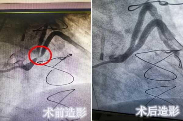 心电搭桥过程（心电搭桥手术要多少钱）-图2