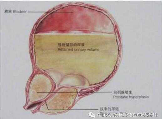 膀胱愈合过程（膀胱的修复能力强吗）-图3