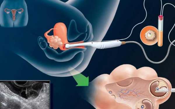 全麻取卵手术过程（全麻取卵手术过程视频）-图3