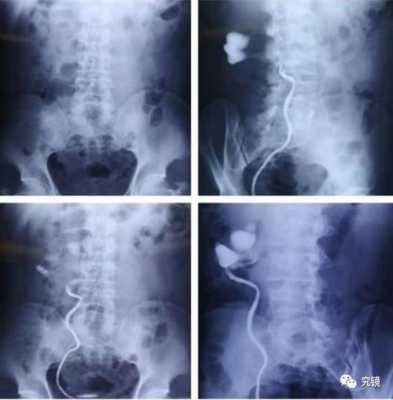 尿路造影的过程（尿路造影注意事项）-图3
