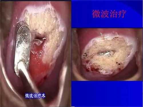 微波治疗宫颈糜烂过程（微波治疗宫颈糜烂过程快吗）-图3