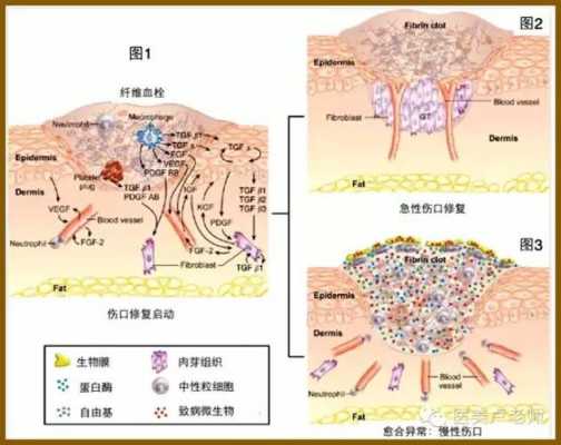 瘢痕愈合病理过程（瘢痕愈合的病理生理过程）-图1