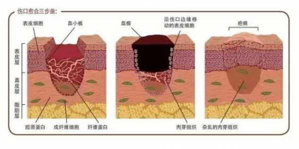 瘢痕愈合病理过程（瘢痕愈合的病理生理过程）-图2