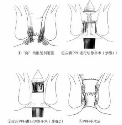 pph手术过程（pph手术过程做多久）-图3