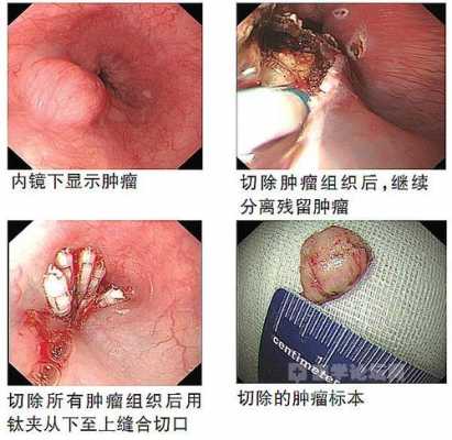 间质瘤手术过程（间质瘤手术费用高不高）-图3