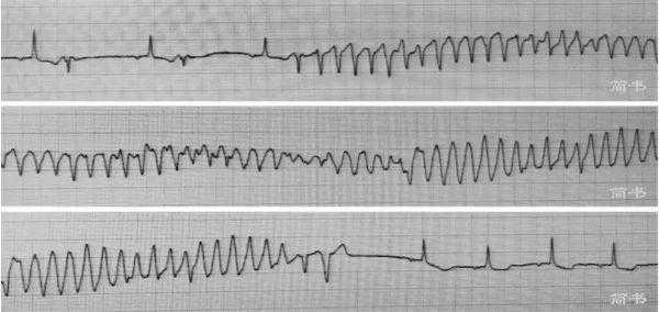 室颤死亡过程（室颤导致死亡的原因）-图2