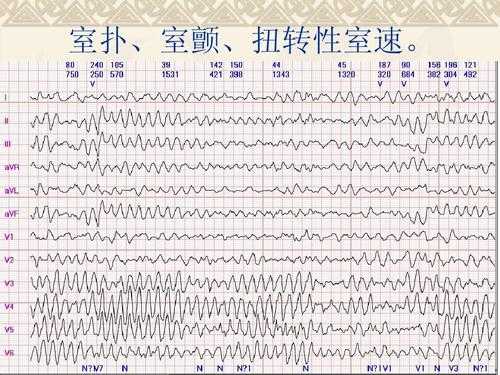 室颤死亡过程（室颤导致死亡的原因）-图1