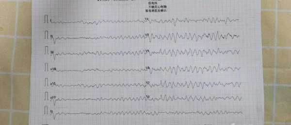 室颤死亡过程（室颤导致死亡的原因）-图3