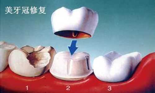 冠修复过程（冠修复的条件）-图2