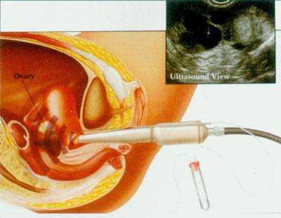 妇幼做人工受精过程（妇幼医院人工受精好不好）-图2