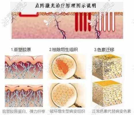 激皮治愈过程（皮肤激光治疗一次大概多少钱）-图1