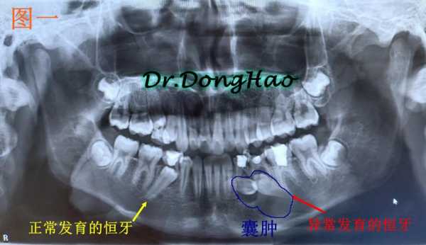 牙齿囊肿的形成过程（牙齿囊肿该怎么办）-图3