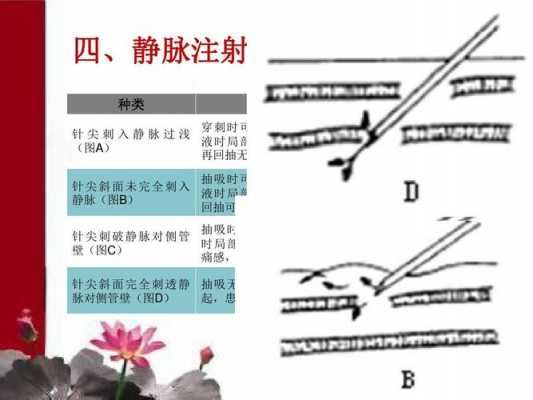 下肢注射静脉循环过程（下肢静脉注射有风险）-图3