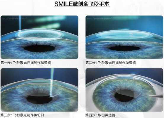 飞秒激光手术过程（飞秒激光手术过程时间）-图1