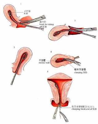 女性带环手术过程图（女性带环手术对身体有影响吗）-图1