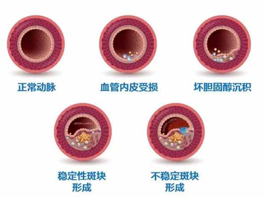 冠状动脉粥样硬化过程（冠状动脉粥样硬化过程图）-图3