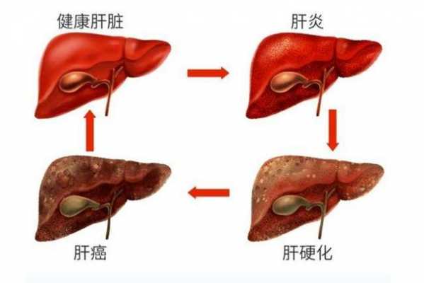 肝硬化病变过程（肝硬化病变是怎么回事）-图3