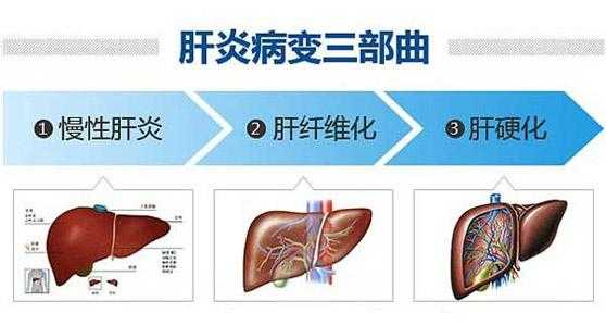 肝硬化病变过程（肝硬化病变是怎么回事）-图2