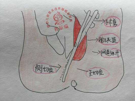 侧切视频全过程视频（侧切演示视频）-图1