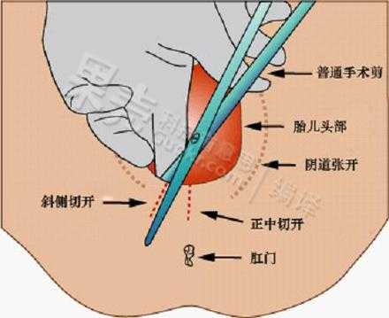 侧切视频全过程视频（侧切演示视频）-图2