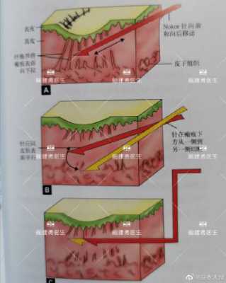 插入过程中萎缩的简单介绍-图3