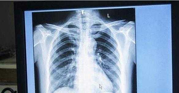 胸透的具体过程（胸透有几种方法）-图3