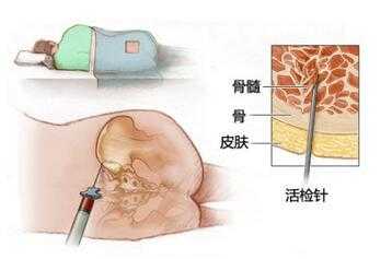 做骨穿刺过程（骨穿刺手术是怎么做的?）-图3