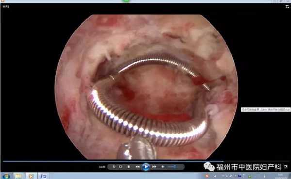 宫腔镜手术全过程（宫腔镜手术费用大概多少钱）-图3