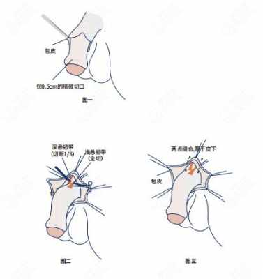 包含延长阴茎手术过程图的词条-图1