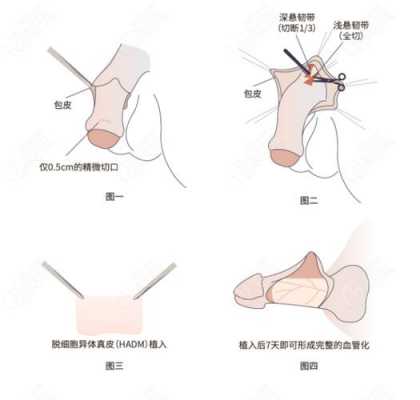 包含延长阴茎手术过程图的词条-图2