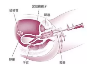 宫腔镜疏通输卵管过程（宫腔镜疏通输卵管手术费用多少）-图1