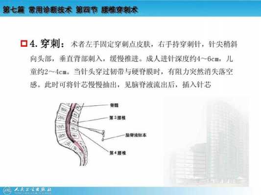 腰穿手术过程（腰穿手术步骤）-图1