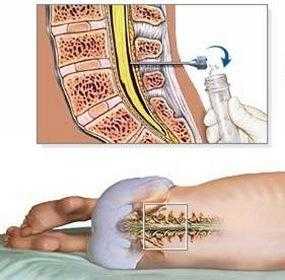 腰穿手术过程（腰穿手术步骤）-图2