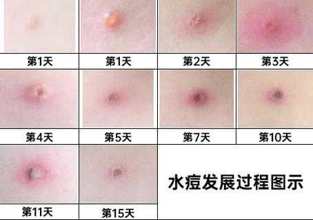 水痘的愈合过程图片（水痘的愈合的过程）-图1