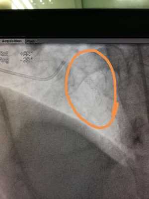 造影检查的过程（造影检查过程中告知做支架）-图2