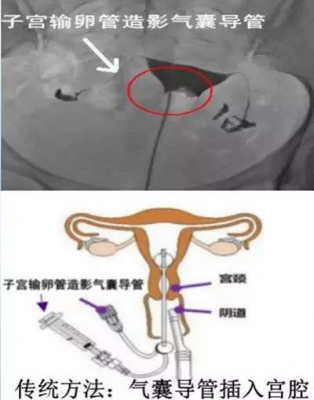 输卵管造影过程多久（做输卵管造影过程多久）-图1